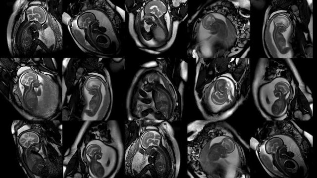tock footage embryo, fetus, germ, foetus, fetus, nucleus, egg, foetus MRI