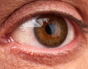 open eye of a man with red vessels, allergic reaction of the body