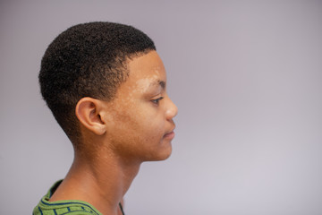Obraz premium Close up portrait of teenager with skin condition