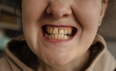 Crooked teeth. Crooked teeth. Dental clinic patient. Dental care. Teeth whitening. Portrait of...
