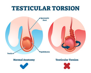 Testicular torsion vector illustration. Labeled spermatic cord twist scheme - obrazy, fototapety, plakaty