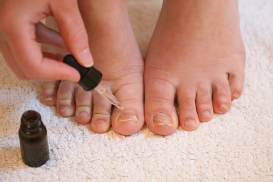 feet with toe nail fungus 