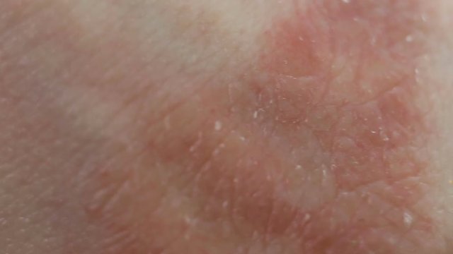 The affected skin is extremely close-up, real time, contains people. Atopic dermatitis from stress, allergies, fungal or bacterial infection, systemic lupus erythematosus, autoimmune processes. Red sp