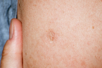 Close up of Bacillus Calmette-Guérin (BCG) vaccine scar mark in the upper left arm of an adult person; BCG vaccine is usually administered to newborns and primarily used against tuberculosis (TB)