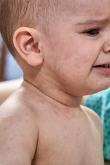 Obraz premium roseola rash a viral rash on the skin of a child