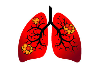 Comparison between healthy lung and cancer lung isolated on white background. Healthy lung and 
Pneumonia. Lung was infected by pathogen 