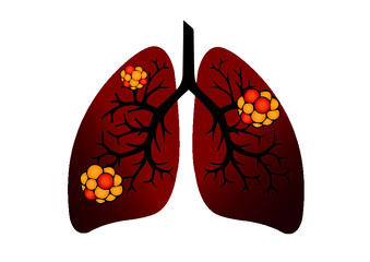Comparison between healthy lung and cancer lung isolated on white background. Healthy lung and 
Pneumonia. Lung was infected by pathogen 