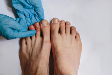 Mysterious skin condition that causes purple, blue or red discoloration in toes and occasionally...
