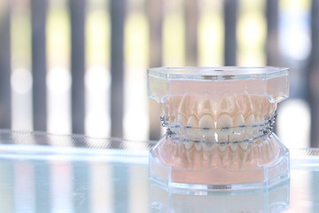 ブラケット付き歯列模型