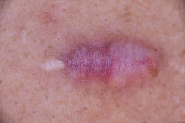 Fototapeta premium Surgical scar morphed into keloid