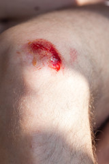 Fototapeta premium Deep scratches on the skin with bruises and wet tracks