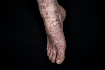 Fototapeta premium Psoriasis (eczema) on foot isolated on black background