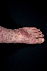 Psoriasis (eczema) on foot isolated on black background