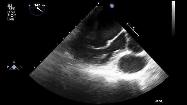Transesophageal ultrasound video in gray-scale mode.