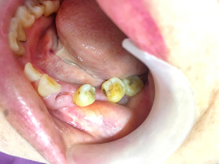 Decayed teeth in the women mouth with dentist hand