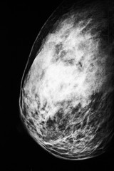 X-ray of a female breast