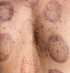 Fototapeta premium Woman with back marks from medical therapy.