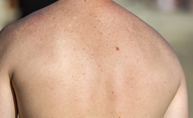 The bare back of a man with traces of freckles.