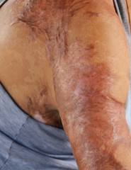 Naklejka premium A large scar on human skin