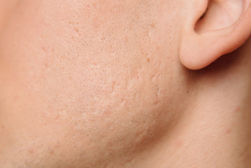 Fototapeta premium Acne scars on the face