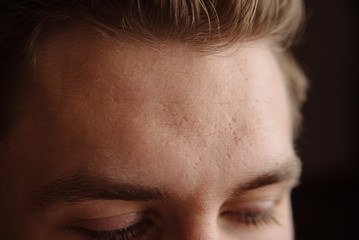 Acne scars on the face