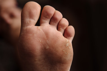 Obraz premium Fungus on the toes close up