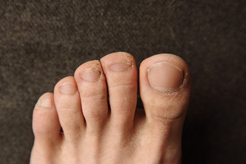 Fungus on the toes close up