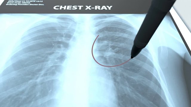The radiologist examines x-rays images of the patient's lungs and makes a medical conclusion. The x-ray shows inflammation of the lungs. This diagnosis writes in the medical description.