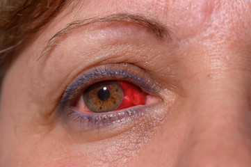 Obraz premium Frau mit Bindehautentzündung im Auge