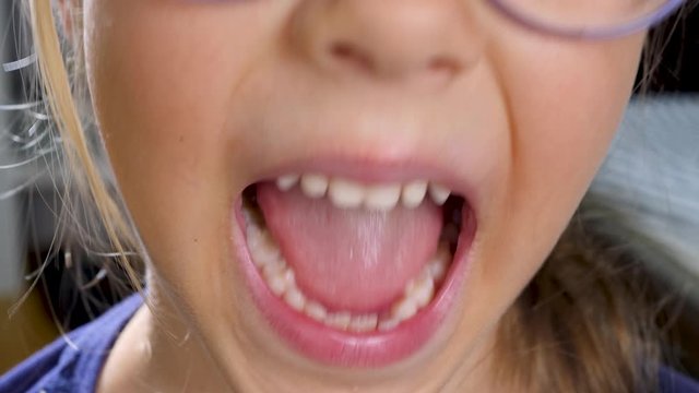 Little cute child girl smiles and shows first wobby tooth. Dental medicine or temporary teeth healthcare. Children's mouth with baby teeth or milk teeth