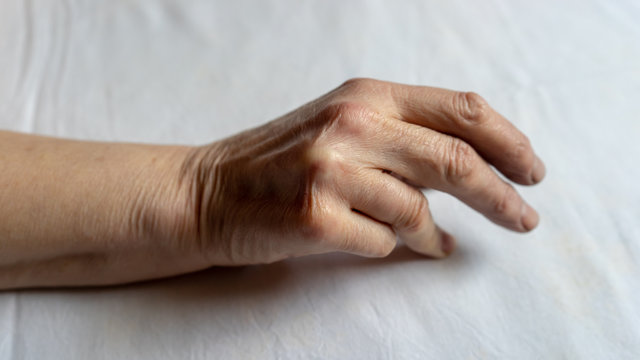 Hands of a woman with twisted fingers. Dupuytren's contracture disease.
