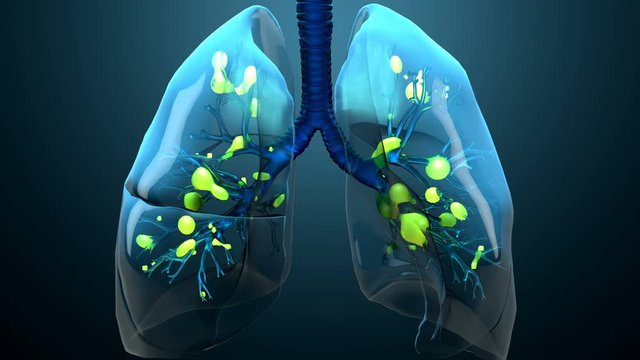Damage lungs, severe respiratory illness, pneumonia, ARDS, acute respiratory distress syndrome caused by the coronavirus