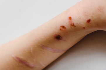 The wound form scabs on hand and arm. Close-up.