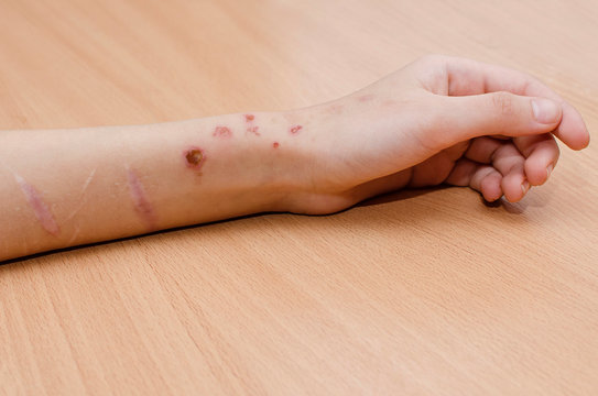 burns and scars from cuts on the arm.