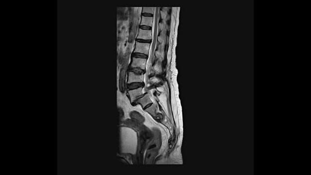 MRI scan of lumbosacral spine in Sagittal view.