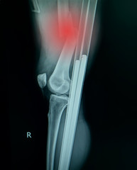 film x-ray of fracture right thigh.
