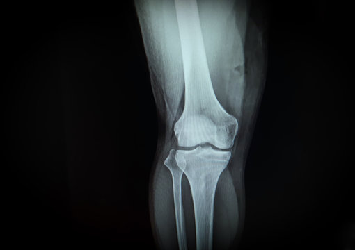 x-ray image show right knee front.