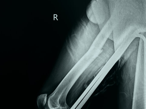 film x-ray of fracture right thigh.