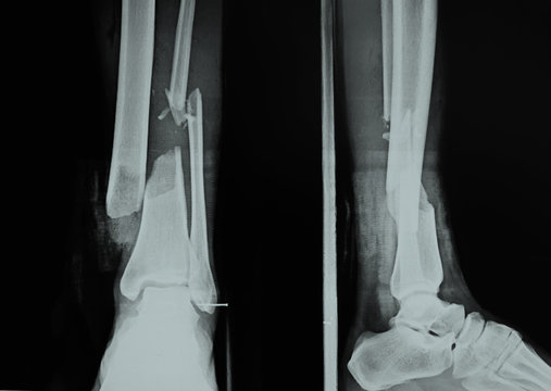 film x-ray of fracture of left ankle.