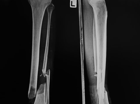 close up, film x-ray of side fracture of left ankle.