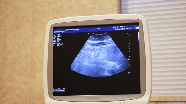 A monitor of a working, modern ultrasound machine is shown on which a medical study is performed. The smooth movement of the camera. Close-up. Soft white light.