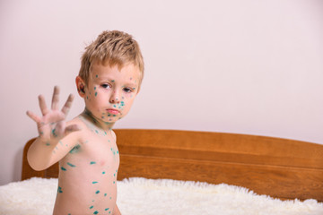 Young toddler,boy with chickenpox. Sick child with chickenpox. Varicella virus or Chickenpox bubble...