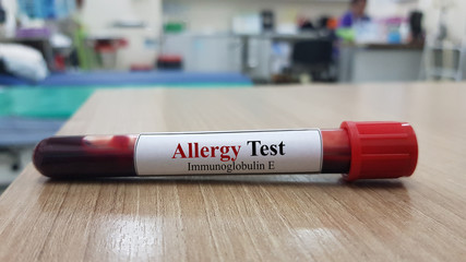 Laboratory of blood testing for Allergy test. Allergy testing for detect allergen substance cause allergic reaction by measure IgE antibodies. Medical investigation and diagnostic technology concept.