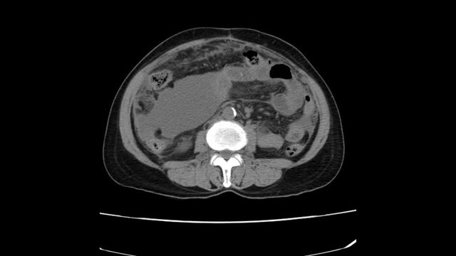 CT Whole abdomen  finding fatty mass with calcification at Rt adnexa, representing dermoid cyst.