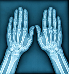 X ray Image of both human hands