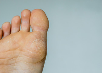 close-up of the foot, dry skin, unkempt foot
