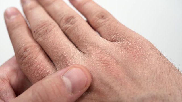 Close-up of a Caucasian man's hand with severely dry and cracked skin after using alcohol-based disinfectant solutions during the coronavirus (Covid-19, SARS-CoV-2) pandemic. Skin rashes, dermatitis.