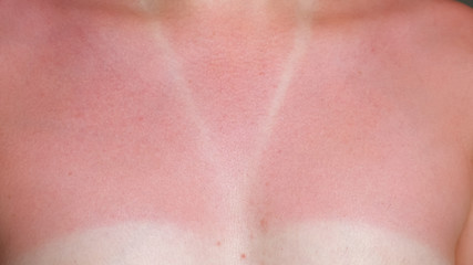 Fototapeta premium young woman sunburned bare chest and neck with red suntan around white designed swimsuit imprint close-up