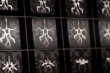 MRT images of the human head vessels