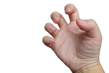 Hands peeling caused by vitamin A deficiency. Have clipping path. 